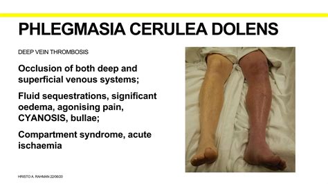 Plegmasia Alba And Cerulea Dolens Ppt