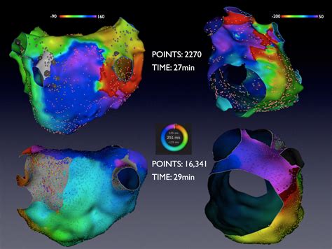 Evaluation Of A Novel High Resolution Mapping Technology For Ablation