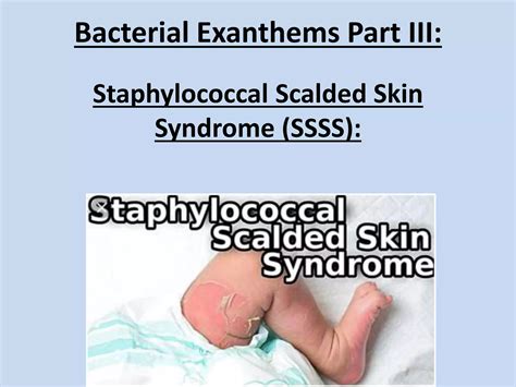 Scaled Skin Syndrome Pdf