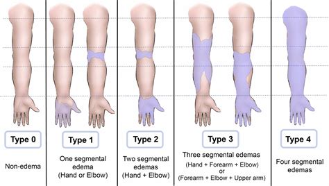 Progression Of Fluid Infiltration On Non Contrast Magnetic Resonance