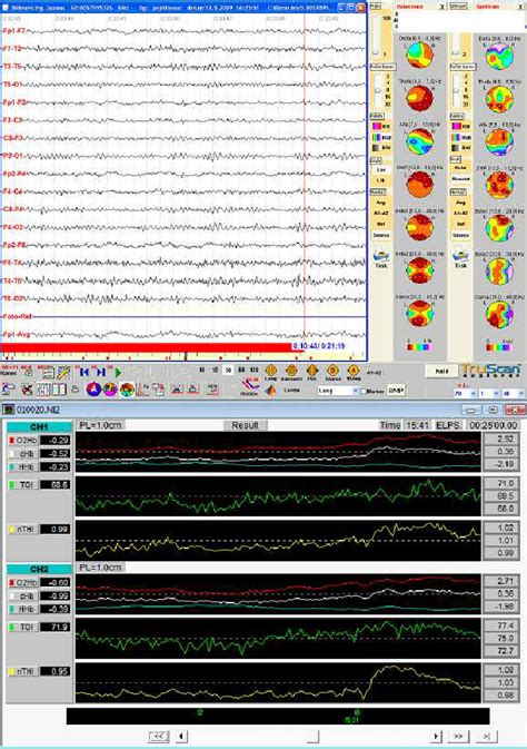 Apnoea 1 Ap 1 Lasting 35 Sec Eeg Alpha Slightly Increases Nirs