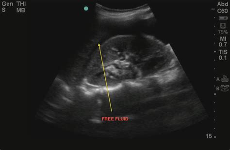 Ruptured Ectopic Pregnancy Ultrasound