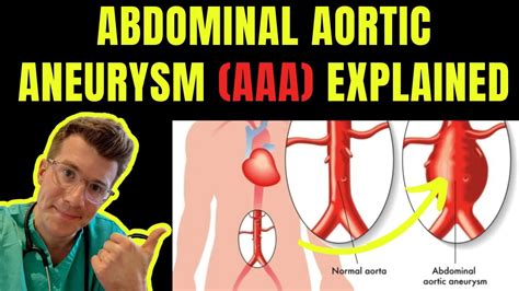 Abdominal Aortic Aneurysm