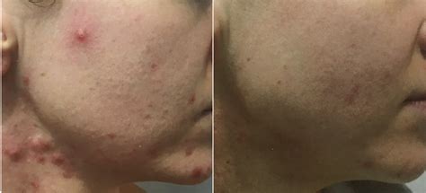 Acne Clinic Treatments Swoon Aesthetic Spa In Wexford Pa