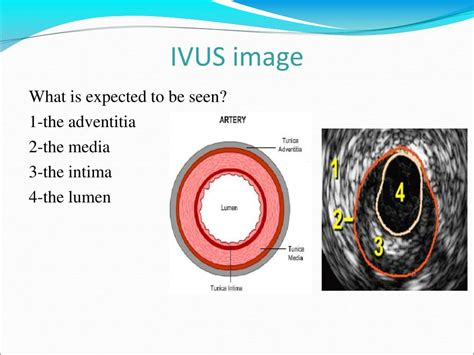 Ppt Angiography Powerpoint Presentation Free Download Id 5177574