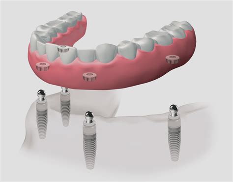 Ltima Tecnolog A Para Implantes Dentales En Le N