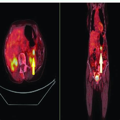 Pet Ct Incidental Detection Of Cancer Of The Sigmoid Colon Months