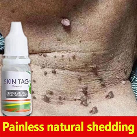 Effective Pure Kasoy Oil Warts Remover Mole Skin Tag Kulugo Genital