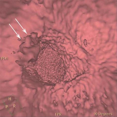 Mobile Aortic Valve Vegetation In A Patient With Infective Endocarditis