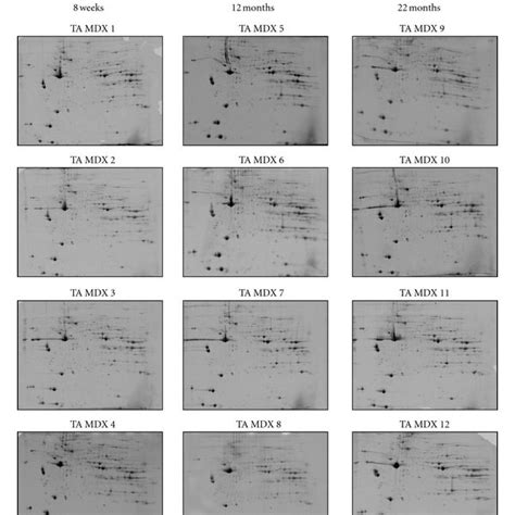 Two Dimensional Gel Electrophoretic Analysis Of Aging Mdx Tibialis