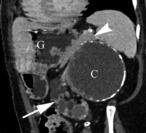 Peripancreatic Masses That Simulate Pancreatic Disease Spectrum Of