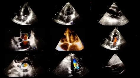 Echocardiography (ultrasound examination... | Stock Video | Pond5