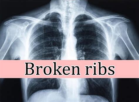 Broken Or Bruised Ribs Types Causes Symptoms Risks Sexiz Pix