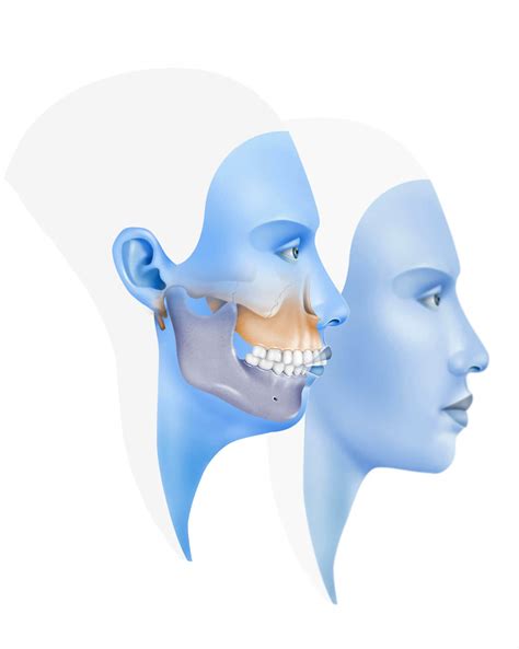 Clase Ii O Retrognatia Mandibular Cirugía Ortognática Instituto Maxilofacial