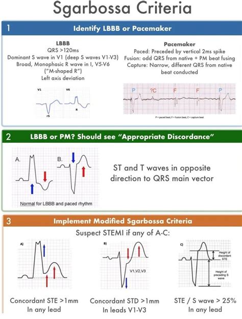 Sgarbossa Criteria MEDizzy