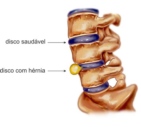 Hernia Discal O De Disco Lumbar Que Es Causas Sintomas Y Tratamiento Images