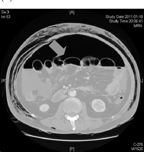 Figure 2 From Tension Penumoperitoneum Following Routine Colonoscopy