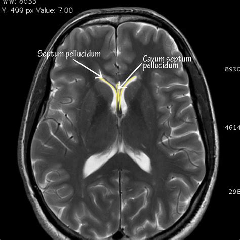 Neuroanatomy Glossary Cavum Septum Pellucidum Ditki Medical