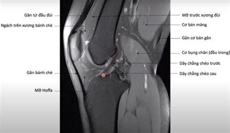 Cách đọc Phim Mri Khớp Gối Pgs Hà Hoàng Kiệm