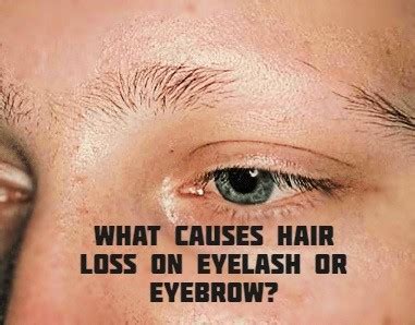 What causes hair loss on eyelash or eyebrow? - HealthZigZag