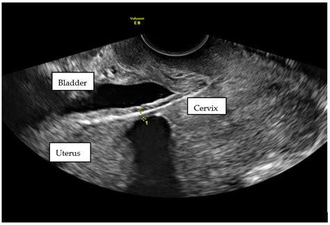 Ijerph Free Full Text Scar Tissue After A Cesarean Section—the