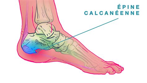 L Pine Calcan Enne Apon Vrosite Plantaire Santemeds