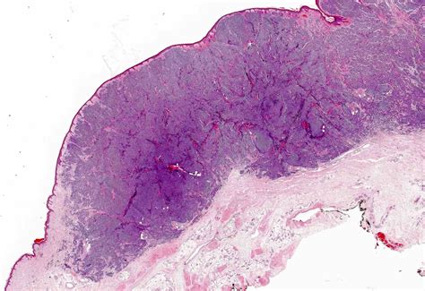 Pathology Outlines Merkel Cell Carcinoma