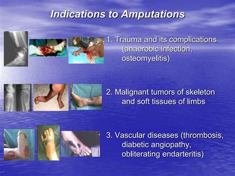 Amputations And Disarticulations In Limbs Ppt