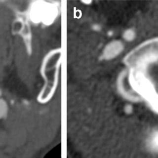 Ct Angiography A Axial Ct Angiogram Image Of The Neck In The