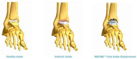 Traumatic Arthropathy Foot And Ankle