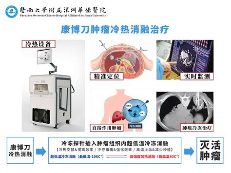 康博刀肿瘤冷热消融临床应用上的先进治瘤技术 暨南大学附属深圳华侨医院