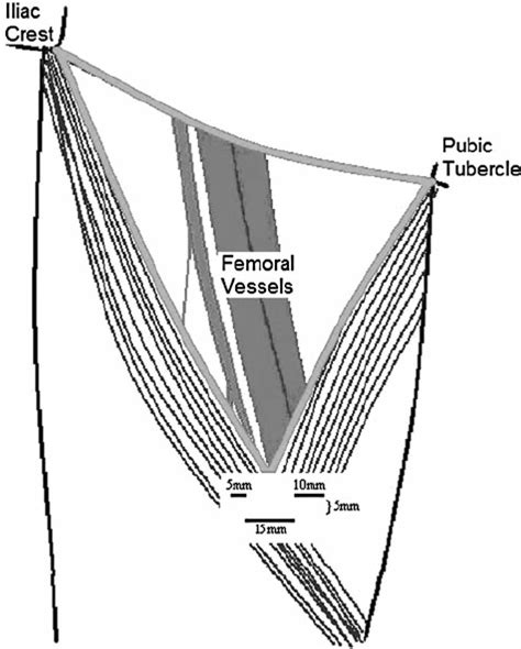 Inguinal Triangle Boundaries