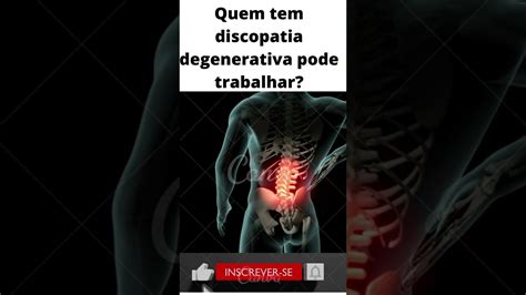 O Que Discopatia Degenerativa Difusa Resolvido Ame Jumelle