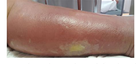 Figure 1 From An Update On The Treatment And Management Of Cellulitis Semantic Scholar