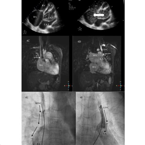 Contrast Transthoracic Echocardiography In Apical 4 Chamber View With