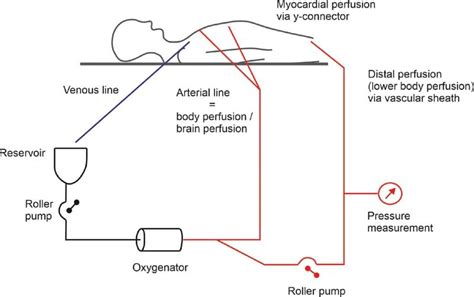 Schematic Drawing Of Extracorporeal Circulation Set Up During Beating