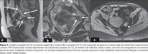 Scielo Brasil Resson Ncia Magn Tica Na Endometriose P Lvica