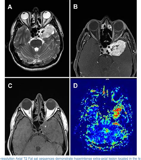 Figure From Parasellar Extra Axial Cavernoma Mimicking Meningioma A