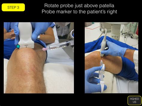 Arthrocentesis: Knee — Highland EM Ultrasound Fueled pain management