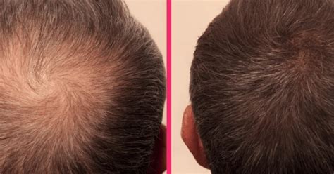 Prf Hair Treatment For Hair Loss Restoration Smooth Synergy Medical