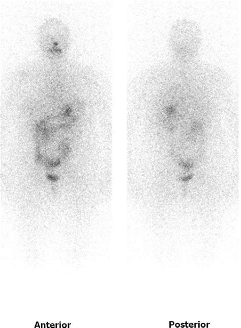 Anterior And Posterior Pre I Therapy Planar Whole Body Scan