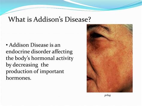 Ppt Addisons Disease Powerpoint Presentation Free Download Id2843179