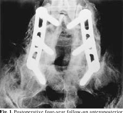 Figure From Lumbar Spinal Fusion With Pedicle Screw Fixation In The