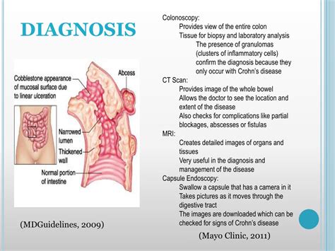 Ppt Crohn’s Disease Powerpoint Presentation Free Download Id 3480640