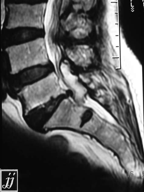 Intradural extramedullary tumor – Radiopaedia