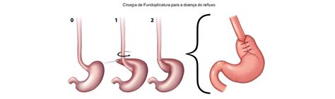 H Rnia De Hiato E Refluxo Gastroesof Gico Dr Vin Cius Cordeiro