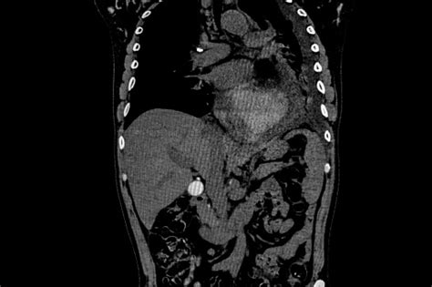 Computer Tomography Angiography Cta Of Whole Body Scan With 3d Reconstruction Ct Angiography For