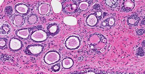 Adenoid Cystic Carcinoma - MyBioSource Learning Center