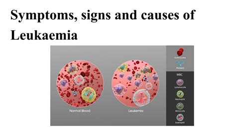 Symptoms Signs And Causes Of Leukaemia By Shravanp Issuu