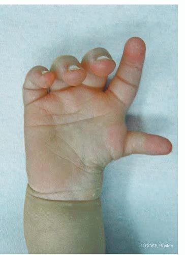 Thumb Hypoplasia Musculoskeletal Key